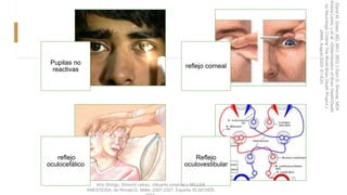 Pupilas no
reactivas
reflejo corneal
reflejo
oculocefálico
Reflejo
oculovestibular
Kho Shingu, Shinichi nakao. «Muerte cerebral.» MILLER
ANESTESIA, de Ronald D. Miller, 2307-2327. España: ELSEVIER,
David
M.
Greer,
MD,
MA1,
MD2,3
Sam
D.
Shemie,
MD4
Ariane
Lewis,
y
et
al.
«Determination
of
Brain
Death/Death
by
Neurologic
Criteria
The
World
Brain
Death
Project.»
JAMA,
August
2020:
E1-E20
 