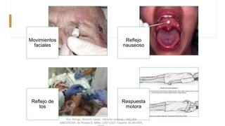 Movimientos
faciales
Reflejo
nauseoso
Reflejo de
tos
Respuesta
motora
Kho Shingu, Shinichi nakao. «Muerte cerebral.» MILLER
ANESTESIA, de Ronald D. Miller, 2307-2327. España: ELSEVIER,
 