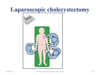 Laparoscopic cholecystectomy
6/1/2023 Dr.Rama-Set up for laparoscopic surgery 76
 