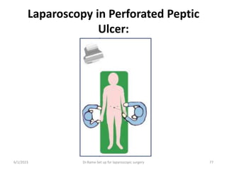 Laparoscopy in Perforated Peptic
Ulcer:
6/1/2023 Dr.Rama-Set up for laparoscopic surgery 77
 
