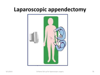 Laparoscopic appendectomy
6/1/2023 Dr.Rama-Set up for laparoscopic surgery 78
 