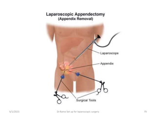 6/1/2023 Dr.Rama-Set up for laparoscopic surgery 79
 