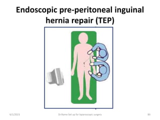 Endoscopic pre-peritoneal inguinal
hernia repair (TEP)
6/1/2023 Dr.Rama-Set up for laparoscopic surgery 80
 