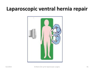 Laparoscopic ventral hernia repair
6/1/2023 Dr.Rama-Set up for laparoscopic surgery 81
 