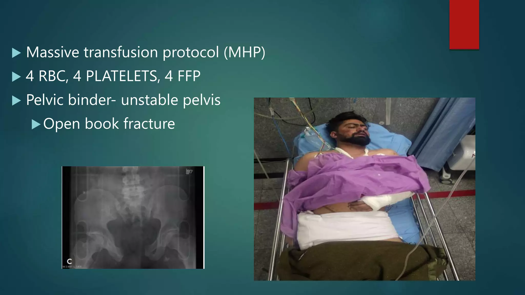  Massive transfusion protocol (MHP)
 4 RBC, 4 PLATELETS, 4 FFP
 Pelvic binder- unstable pelvis
Open book fracture
 