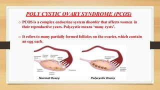 o PCOS is a complex endocrine system disorder that affects women in
their reproductive years. Polycystic means ‘many cysts’.
o It refers to many partially formed follicles on the ovaries, which contain
an egg each.
POLY CYSTIC OVARY SYNDROME (PCOS)
 