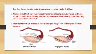 o But they do not grow to maturity or produce eggs that can be fertilized.
o Women with PCOS may experience irregular menstrual cycles, increased androgen
levels, excessive facial orbody hairgrowth (hirsutism), acne, obesity, reduced fertility
and increased risk of diabetes.
o Treatment for PCOS includes a healthy lifestyle, weight loss and targeted hormone
therapy.
 