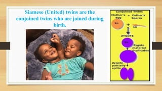 Siamese (United) twins are the
conjoined twins who are joined during
birth.
 