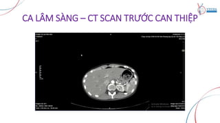 CA LÂM SÀNG – CT SCAN TRƯỚC CAN THIỆP
 