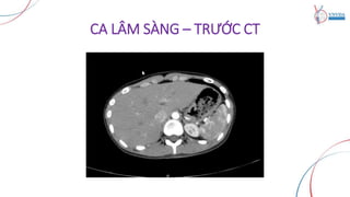 CA LÂM SÀNG – TRƯỚC CT
 