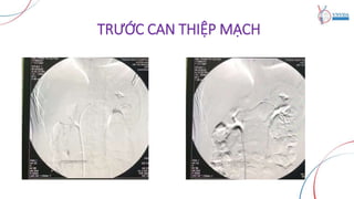 TRƯỚC CAN THIỆP MẠCH
 