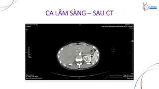 CA LÂM SÀNG – SAU CT
 