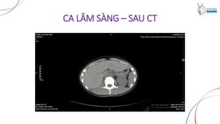 CA LÂM SÀNG – SAU CT
 