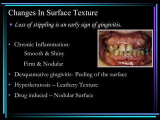 Changes In Surface Texture
• Loss of stippling is an early sign of gingivitis.
• Chronic Inflammation-
Smooth & Shiny
Firm & Nodular
• Desquamative gingivitis- Peeling of the surface
• Hyperkeratosis – Leathery Texture
• Drug induced – Nodular Surface
 