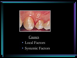 Causes
• Local Factors
• Systemic Factors
 