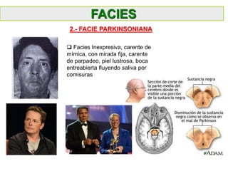  Facies Inexpresiva, carente de
mímica, con mirada fija, carente
de parpadeo, piel lustrosa, boca
entreabierta fluyendo saliva por
comisuras
FACIES
2.- FACIE PARKINSONIANA
 