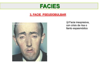  Facie inexpresiva,
con crisis de risa o
llanto espasmódico
FACIES
3, FACIE PSEUDOBULBAR
 