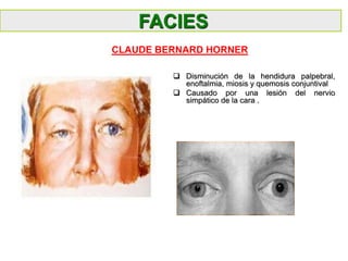 FACIES
CLAUDE BERNARD HORNER
 Disminución de la hendidura palpebral,
enoftalmia, miosis y quemosis conjuntival
 Causado por una lesión del nervio
simpático de la cara .
 