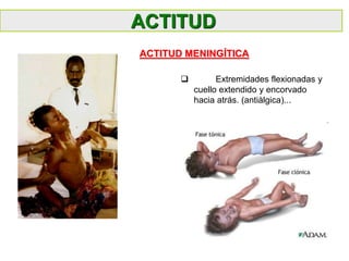  Extremidades flexionadas y
cuello extendido y encorvado
hacia atrás. (antiàlgica)...
ACTITUD MENINGÍTICA
ACTITUD
 