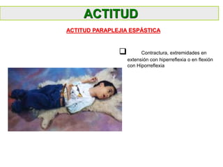  Contractura, extremidades en
extensión con hiperreflexia o en flexión
con Hiporreflexia
ACTITUD PARAPLEJIA ESPÁSTICA
ACTITUD
 
