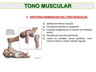  perdida del relieve muscular
 consistencia blanda a la palpación
 motilidad exagerada en el examen de motilidad
pasiva
 Resistencia muscular disminuida.
 Lesión de cerebelo, nervio periférico, moto
neurona inferior y lesión medular (aguda)
2. HIPOTONIA DISMINUCION DEL TONO MUSCULAR
TONO MUSCULAR
 