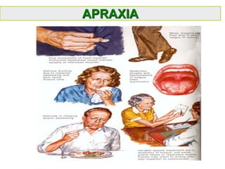 APRAXIA
 