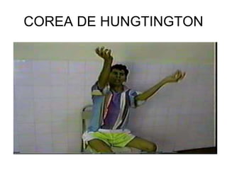 COREA DE HUNGTINGTON
 