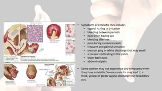• Symptoms of cervicitis may include:
• vaginal itching or irritation
• bleeding between periods
• pain when having sex
• bleeding after sex
• pain during a cervical exam
• frequent and painful urination
• unusual grey or white discharge that may smell
• a pressurized feeling in the pelvis
• lower back pain
• abdominal pain.
• Some women may not experience any symptoms when
they have cervicitis. Severe cervicitis may lead to a
thick, yellow or green vaginal discharge that resembles
pus.
 