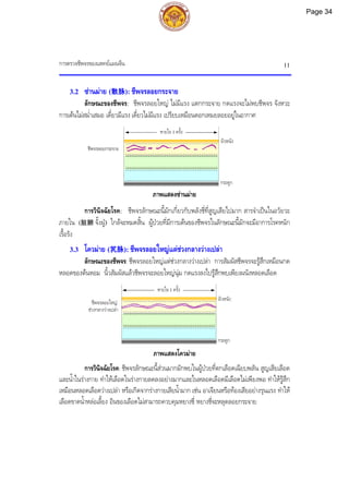 การตรวจชีพจรของแพทยแผนจีน 11
ชีพจรลอยกระจาย
หายใจ 1 ครั้ง
กระดูก
ผิวหนัง
ชีพจรลอยใหญ
ชวงกลางวางเปลา
หายใจ 1 ครั้ง
กระดูก
ผิวหนัง
3.2 ซานมาย (散脉): ชีพจรลอยกระจาย
ลักษณะของชีพจร: ชีพจรลอยใหญ ไมมีแรง แตกกระจาย กดแรงจะไมพบชีพจร จังหวะ
การเตนไมสม่ําเสมอ เดี๋ยวมีแรง เดี๋ยวไมมีแรง เปรียบเหมือนดอกเหมยลอยอยูในอากาศ
ภาพแสดงซานมาย
การวินิจฉัยโรค: ชีพจรลักษณะนี้มักเกี่ยวกับพลังชี่ที่สูญเสียไปมาก สารจําเปนในอวัยวะ
ภายใน (脏腑 จั้งฝู) ใกลจะหมดสิ้น ผูปวยที่มีการเตนของชีพจรในลักษณะนี้มักจะมีอาการโรคหนัก
เรื้อรัง
3.3 โควมาย (芤脉): ชีพจรลอยใหญแตชวงกลางวางเปลา
ลักษณะของชีพจร: ชีพจรลอยใหญแตชวงกลางวางเปลา การสัมผัสชีพจรจะรูสึกเหมือนกด
หลอดของตนหอม นิ้วสัมผัสแลวชีพจรจะลอยใหญนุม กดแรงลงไปรูสึกพบเพียงผนังหลอดเลือด
ภาพแสดงโควมาย
การวินิจฉัยโรค: ชีพจรลักษณะนี้สวนมากมักพบในผูปวยที่ตกเลือดเฉียบพลัน สูญเสียเลือด
และน้ําในรางกาย ทําใหเลือดในรางกายลดลงอยางมากและในหลอดเลือดมีเลือดไมเพียงพอ ทําใหรูสึก
เหมือนหลอดเลือดวางเปลา หรือเกิดจากรางกายเสียน้ํามาก เชน อาเจียนหรือทองเสียอยางรุนแรง ทําให
เลือดขาดน้ําหลอเลี้ยง อินของเลือดไมสามารถควบคุมหยางชี่ หยางชี่จะหลุดลอยกระจาย
Page 34
 