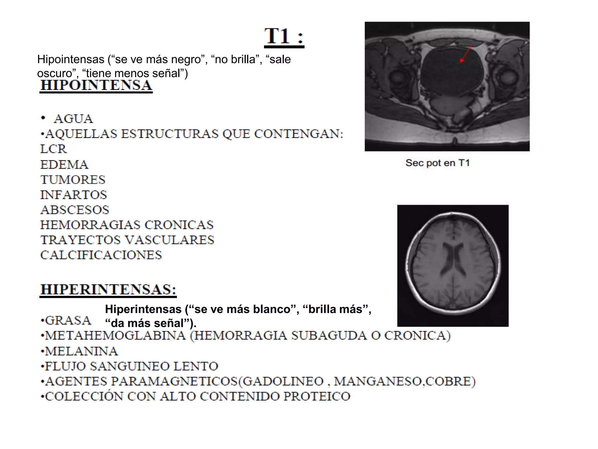 Hipointensas (“se ve más negro”, “no brilla”, “sale
oscuro”, “tiene menos señal”)
Hiperintensas (“se ve más blanco”, “brilla más”,
“da más señal”).
 
