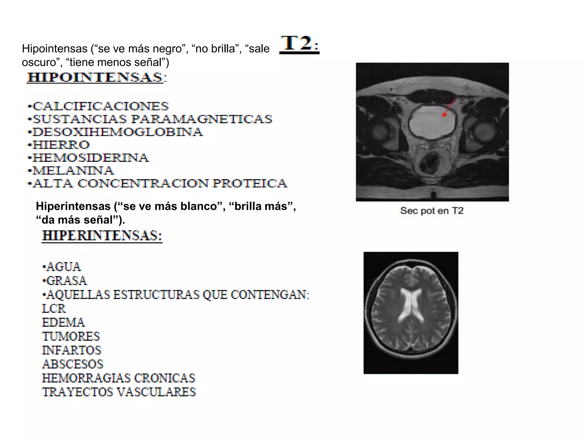 Hipointensas (“se ve más negro”, “no brilla”, “sale
oscuro”, “tiene menos señal”)
Hiperintensas (“se ve más blanco”, “brilla más”,
“da más señal”).
 