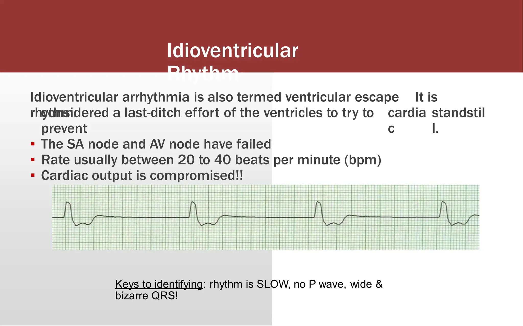 Idioventricular
Rhythm
Idioventricular arrhythmia is also termed ventricular escape
rhythm.
It is
considered a last-ditch effort of the ventricles to try to
prevent
▪ The SA node and AV node have failed
▪ Rate usually between 20 to 40 beats per minute (bpm)
▪ Cardiac output is compromised!!
cardia
c
standstil
l.
Keys to identifying: rhythm is SLOW, no P wave, wide &
bizarre QRS!
 