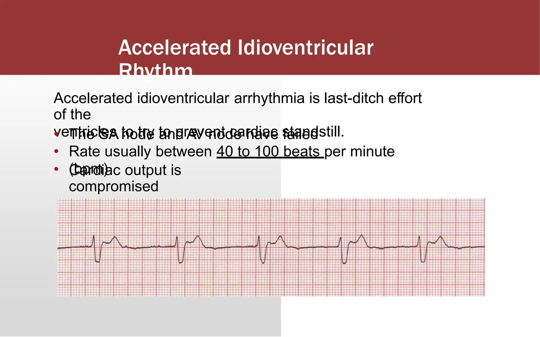 Accelerated Idioventricular
Rhythm
Accelerated idioventricular arrhythmia is last-ditch effort
of the
ventricles to try to prevent cardiac standstill.
•
•
•
The SA node and AV node have failed
Rate usually between 40 to 100 beats per minute
(bpm)
Cardiac output is
compromised
 