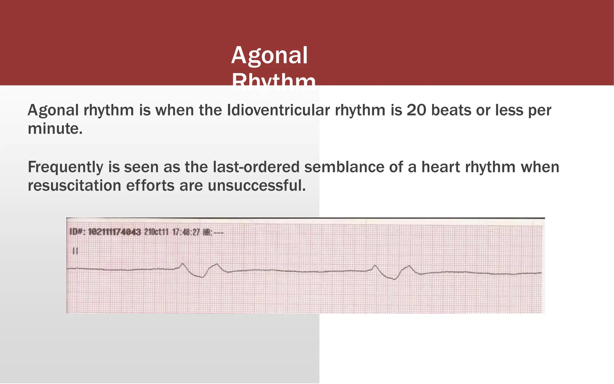 Agonal
Rhythm
Agonal rhythm is when the Idioventricular rhythm is 20 beats or less per
minute.
Frequently is seen as the last-ordered semblance of a heart rhythm when
resuscitation efforts are unsuccessful.
 