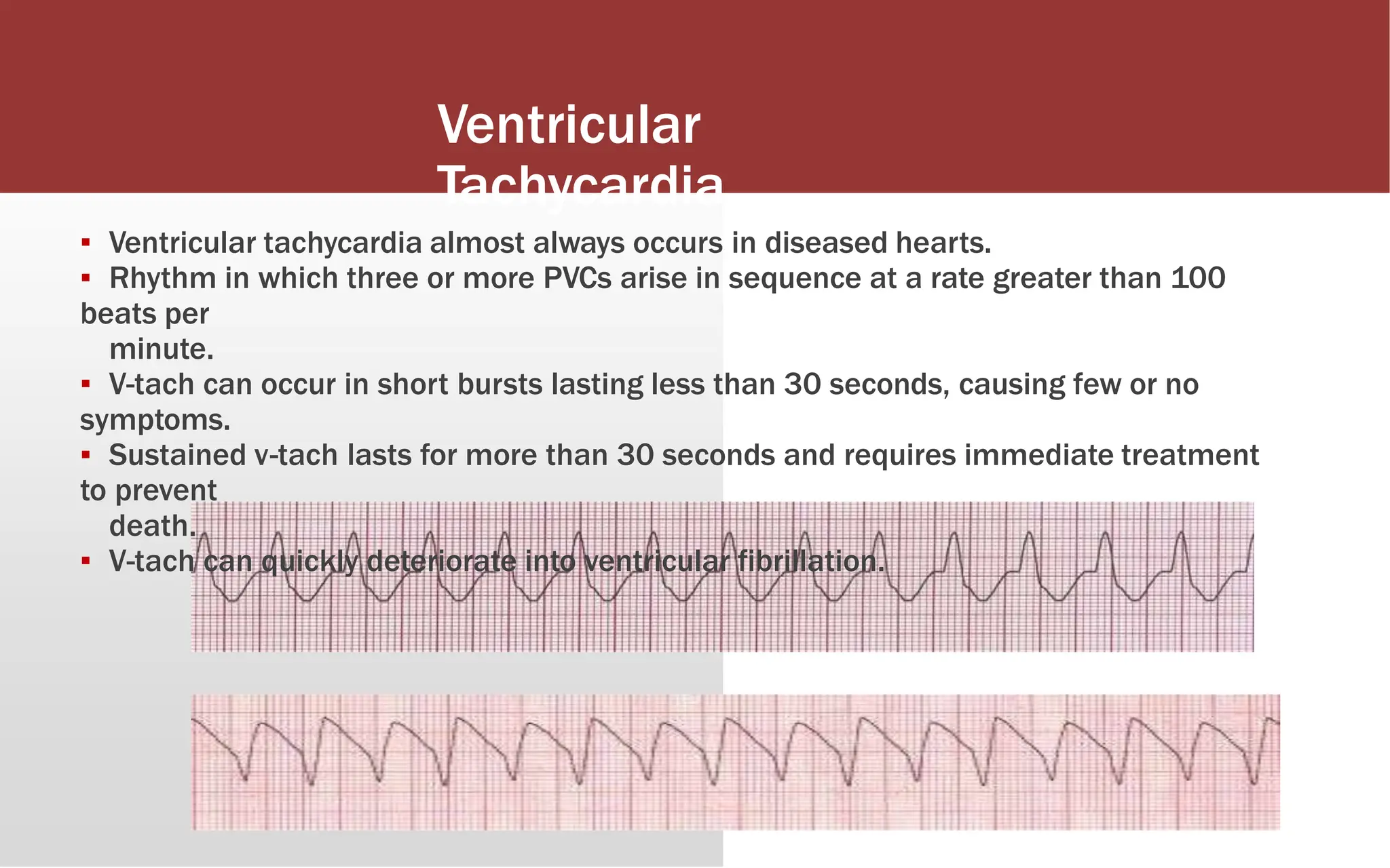 Ventricular
Tachycardia
▪ Ventricular tachycardia almost always occurs in diseased hearts.
▪ Rhythm in which three or more PVCs arise in sequence at a rate greater than 100
beats per
minute.
▪ V-tach can occur in short bursts lasting less than 30 seconds, causing few or no
symptoms.
▪ Sustained v-tach lasts for more than 30 seconds and requires immediate treatment
to prevent
death.
▪ V-tach can quickly deteriorate into ventricular fibrillation.
 