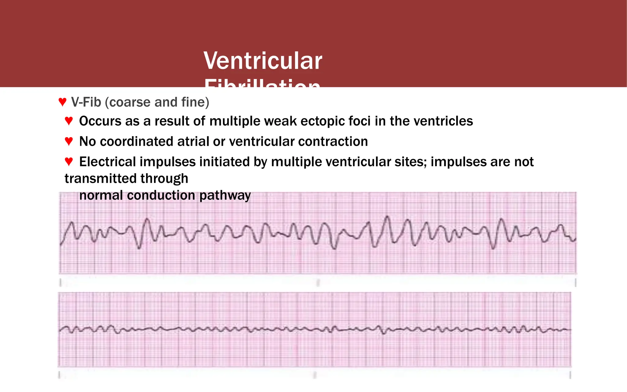 Ventricular
Fibrillation
♥ V-Fib (coarse and fine)
♥ Occurs as a result of multiple weak ectopic foci in the ventricles
♥ No coordinated atrial or ventricular contraction
♥ Electrical impulses initiated by multiple ventricular sites; impulses are not
transmitted through
normal conduction pathway
 