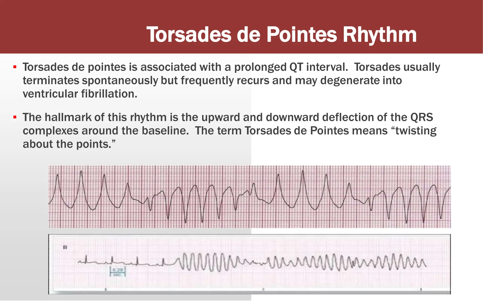 ▪ Torsades de pointes is associated with a prolonged QT interval. Torsades usually
terminates spontaneously but frequently recurs and may degenerate into
ventricular fibrillation.
▪ The hallmark of this rhythm is the upward and downward deflection of the QRS
complexes around the baseline. The term Torsades de Pointes means “twisting
about the points.”
Torsades de Pointes Rhythm
 