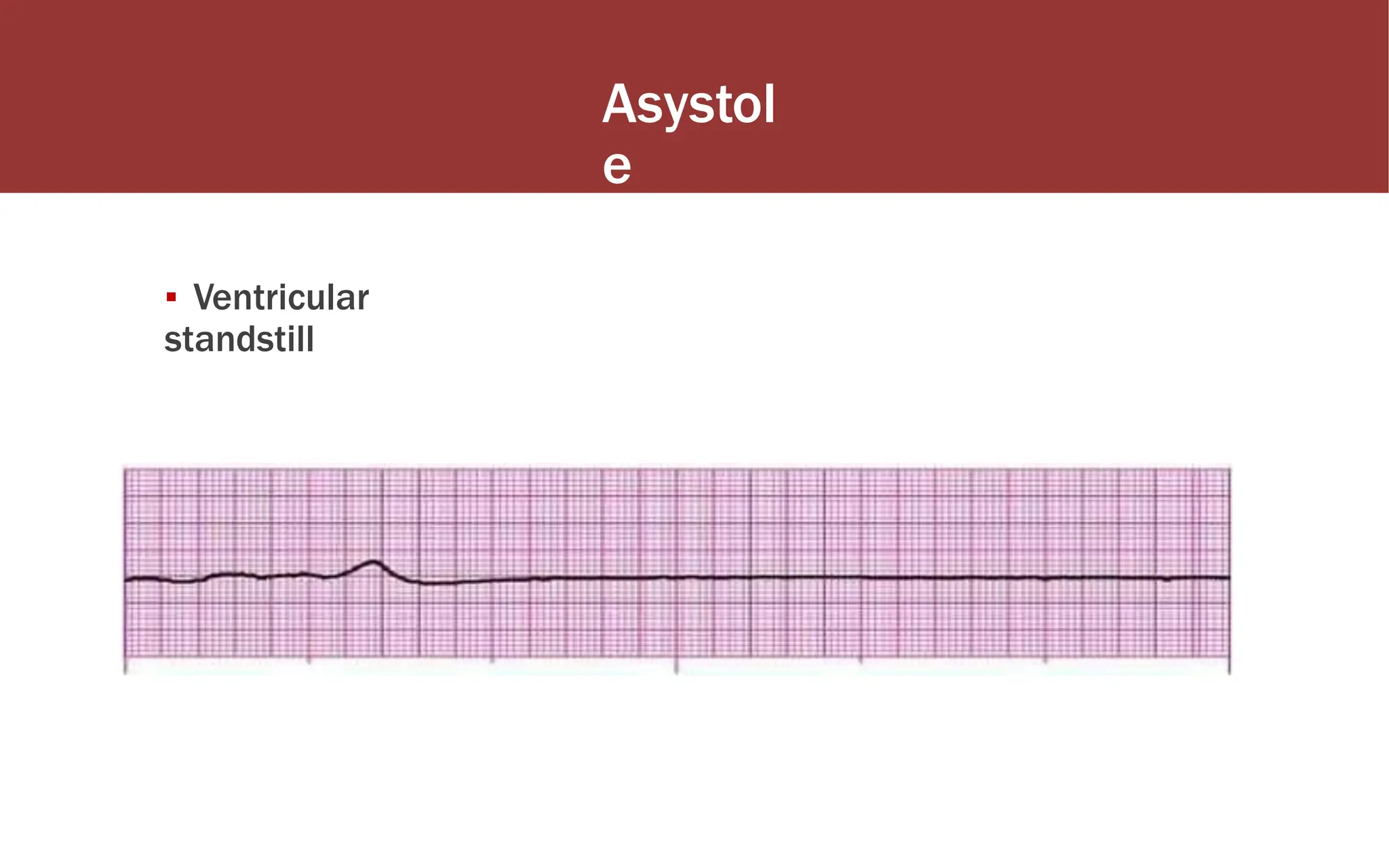 Asystol
e
▪ Ventricular
standstill
 