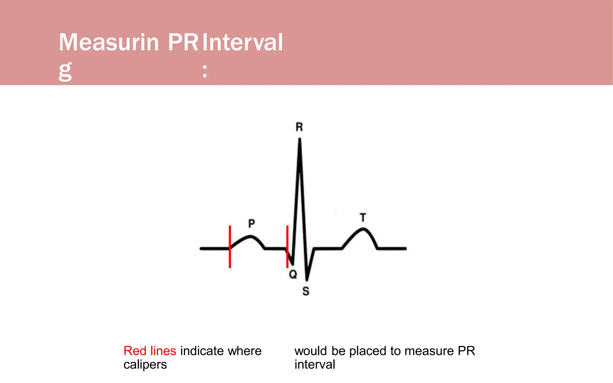 Measurin
g
PRInterval
:
Red lines indicate where
calipers
would be placed to measure PR
interval
 