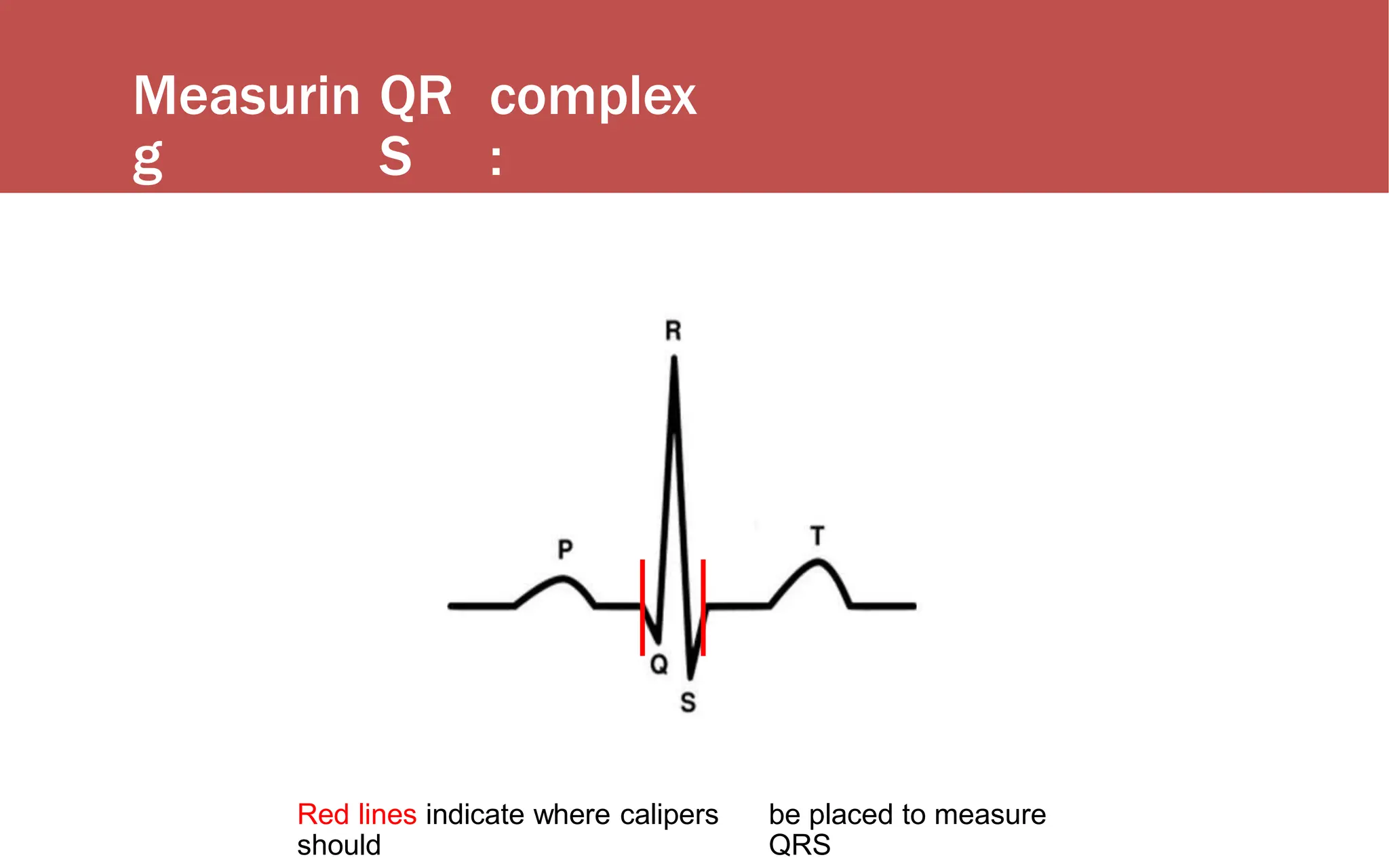 Measurin
g
QR
S
complex
:
Red lines indicate where calipers
should
be placed to measure
QRS
 