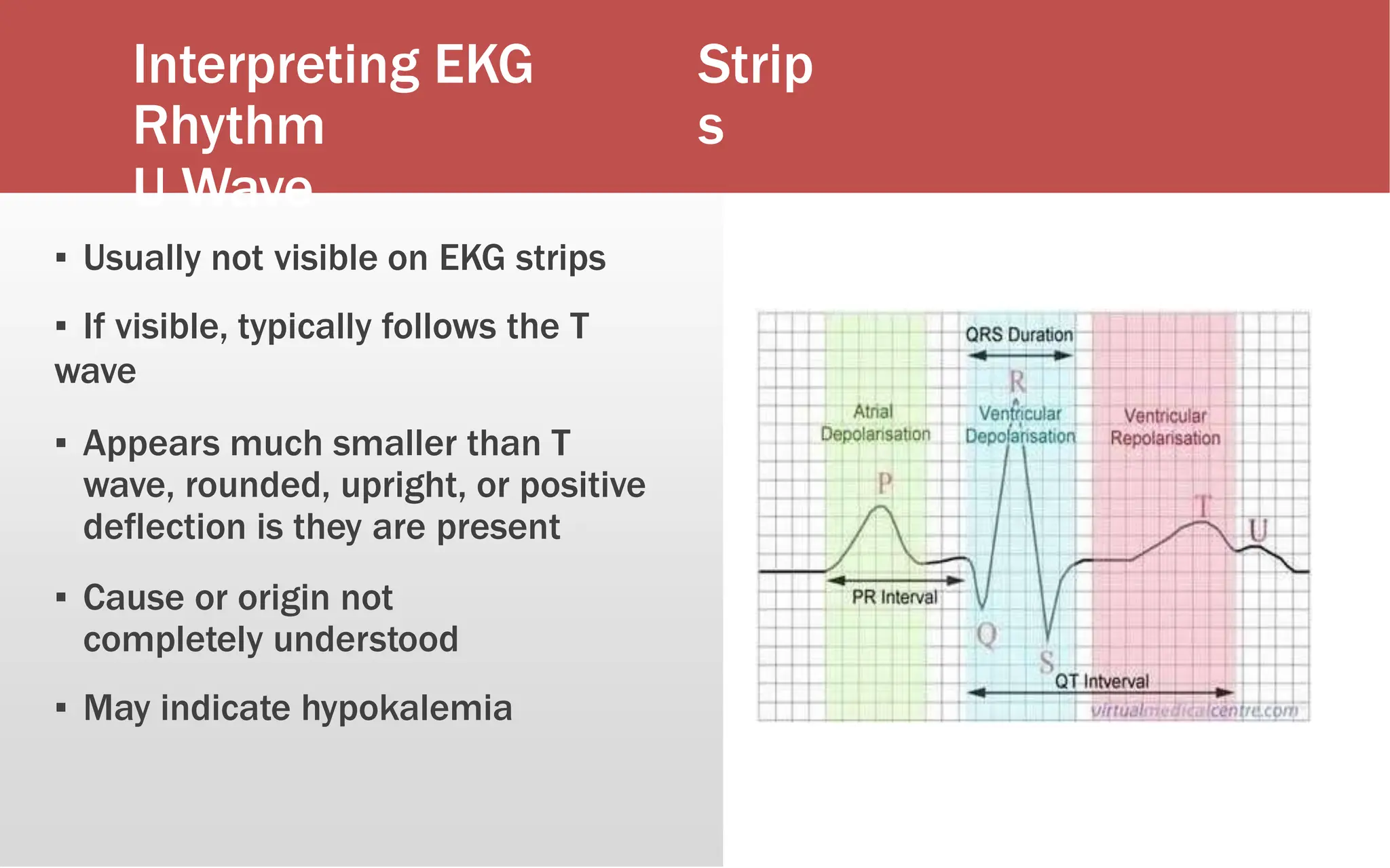 Interpreting EKG
Rhythm
U Wave
Strip
s
▪ Usually not visible on EKG strips
▪ If visible, typically follows the T
wave
▪ Appears much smaller than T
wave, rounded, upright, or positive
deflection is they are present
▪ Cause or origin not
completely understood
▪ May indicate hypokalemia
 