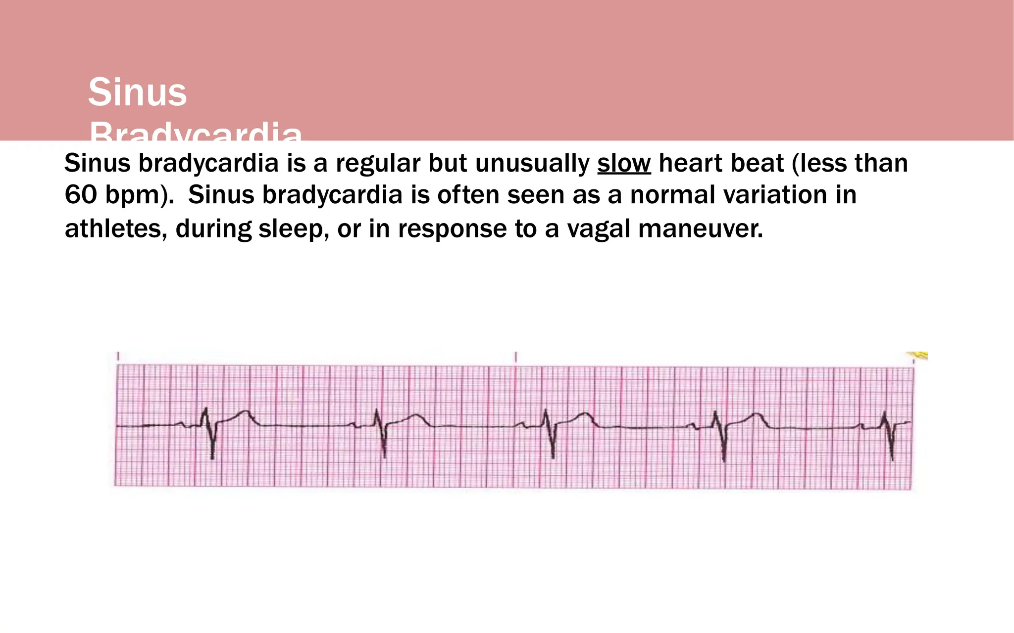 Sinus
Bradycardia
Sinus bradycardia is a regular but unusually slow heart beat (less than
60 bpm). Sinus bradycardia is often seen as a normal variation in
athletes, during sleep, or in response to a vagal maneuver.
 