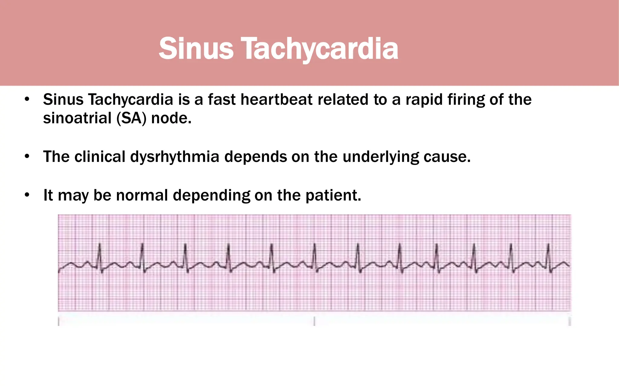 Sinus Tachycardia
• Sinus Tachycardia is a fast heartbeat related to a rapid firing of the
sinoatrial (SA) node.
• The clinical dysrhythmia depends on the underlying cause.
• It may be normal depending on the patient.
 