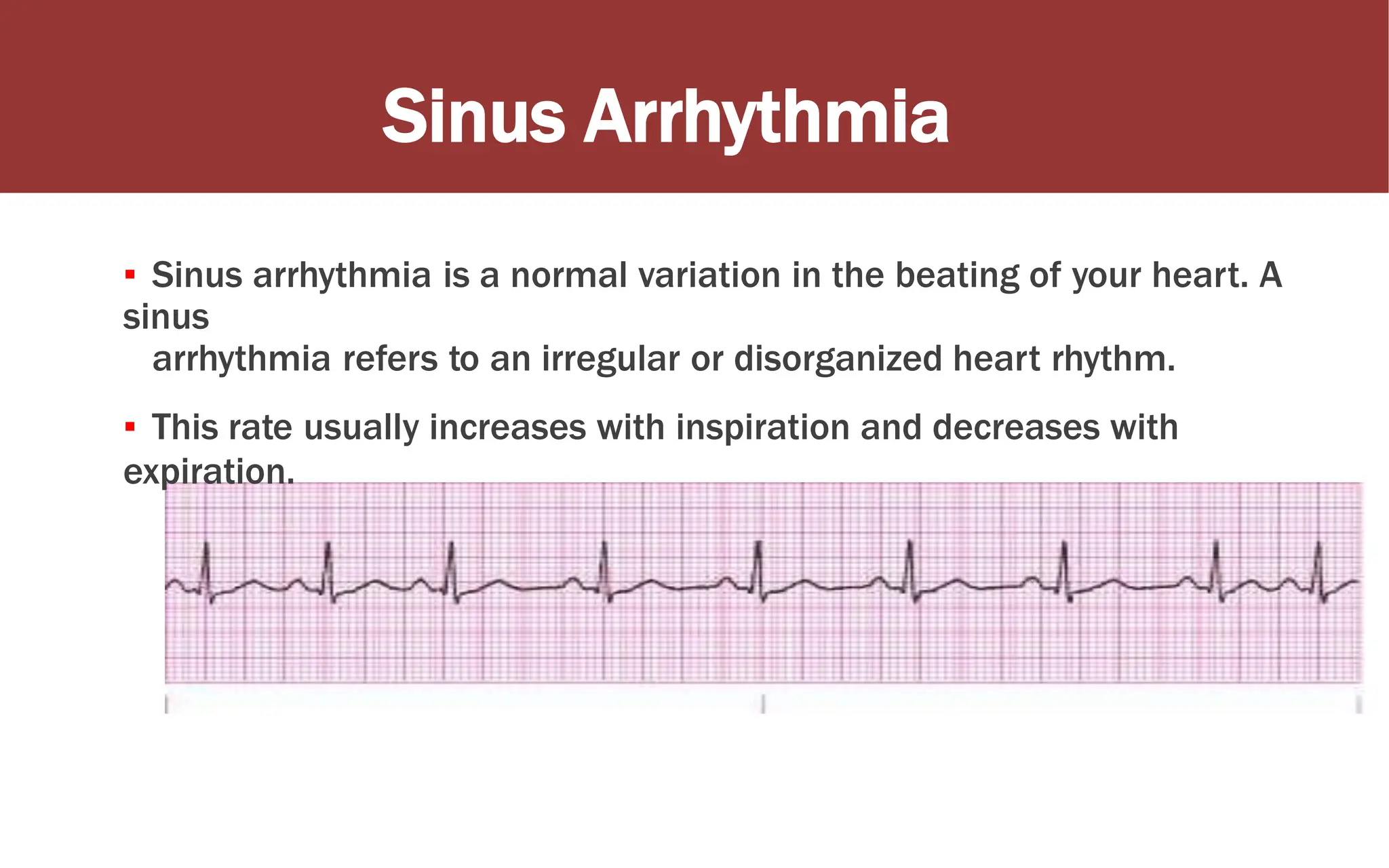 Sinus Arrhythmia
▪ Sinus arrhythmia is a normal variation in the beating of your heart. A
sinus
arrhythmia refers to an irregular or disorganized heart rhythm.
▪ This rate usually increases with inspiration and decreases with
expiration.
 