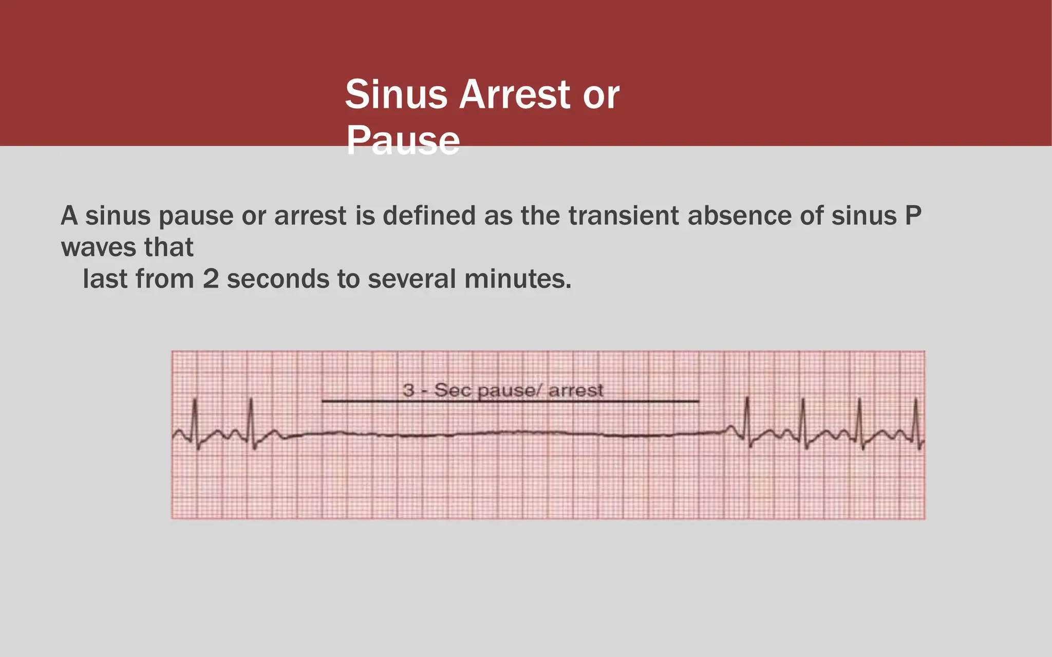Sinus Arrest or
Pause
A sinus pause or arrest is defined as the transient absence of sinus P
waves that
last from 2 seconds to several minutes.
 