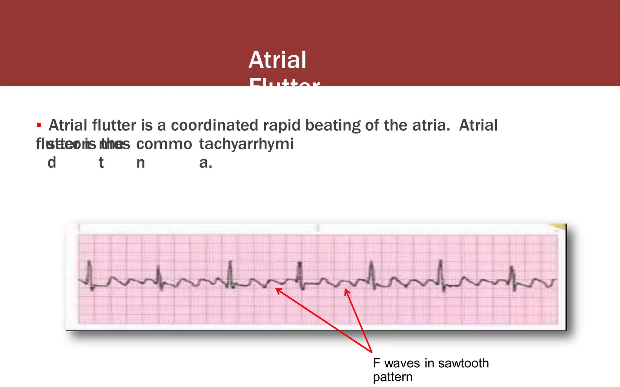 Atrial
Flutter
▪ Atrial flutter is a coordinated rapid beating of the atria. Atrial
flutter is the
secon
d
mos
t
commo
n
tachyarrhymi
a.
F waves in sawtooth
pattern
 