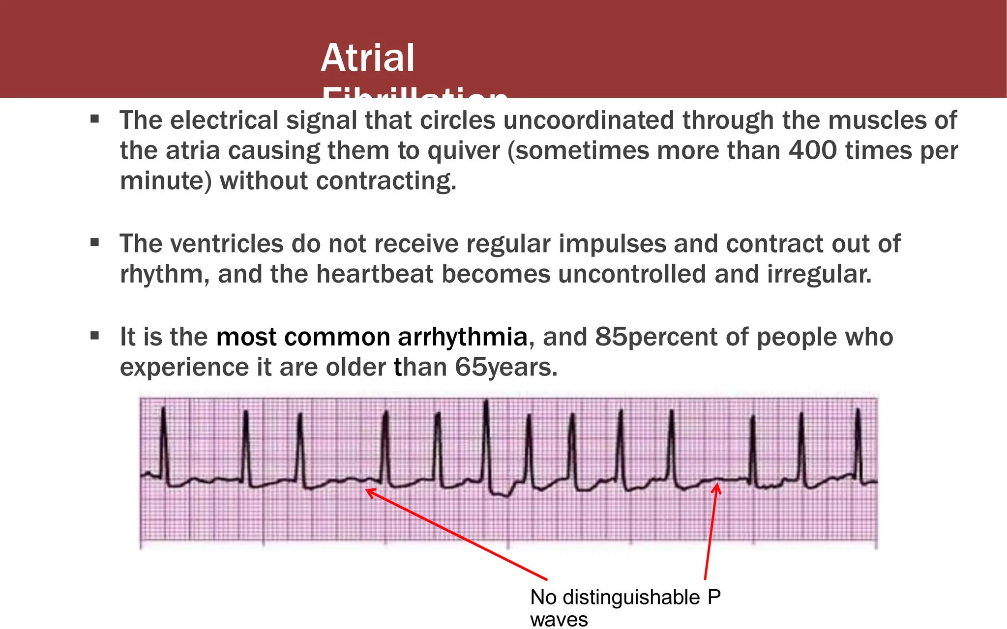 Atrial
Fibrillation
 The electrical signal that circles uncoordinated through the muscles of
the atria causing them to quiver (sometimes more than 400 times per
minute) without contracting.
 The ventricles do not receive regular impulses and contract out of
rhythm, and the heartbeat becomes uncontrolled and irregular.
 It is the most common arrhythmia, and 85percent of people who
experience it are older than 65years.
No distinguishable P
waves
 