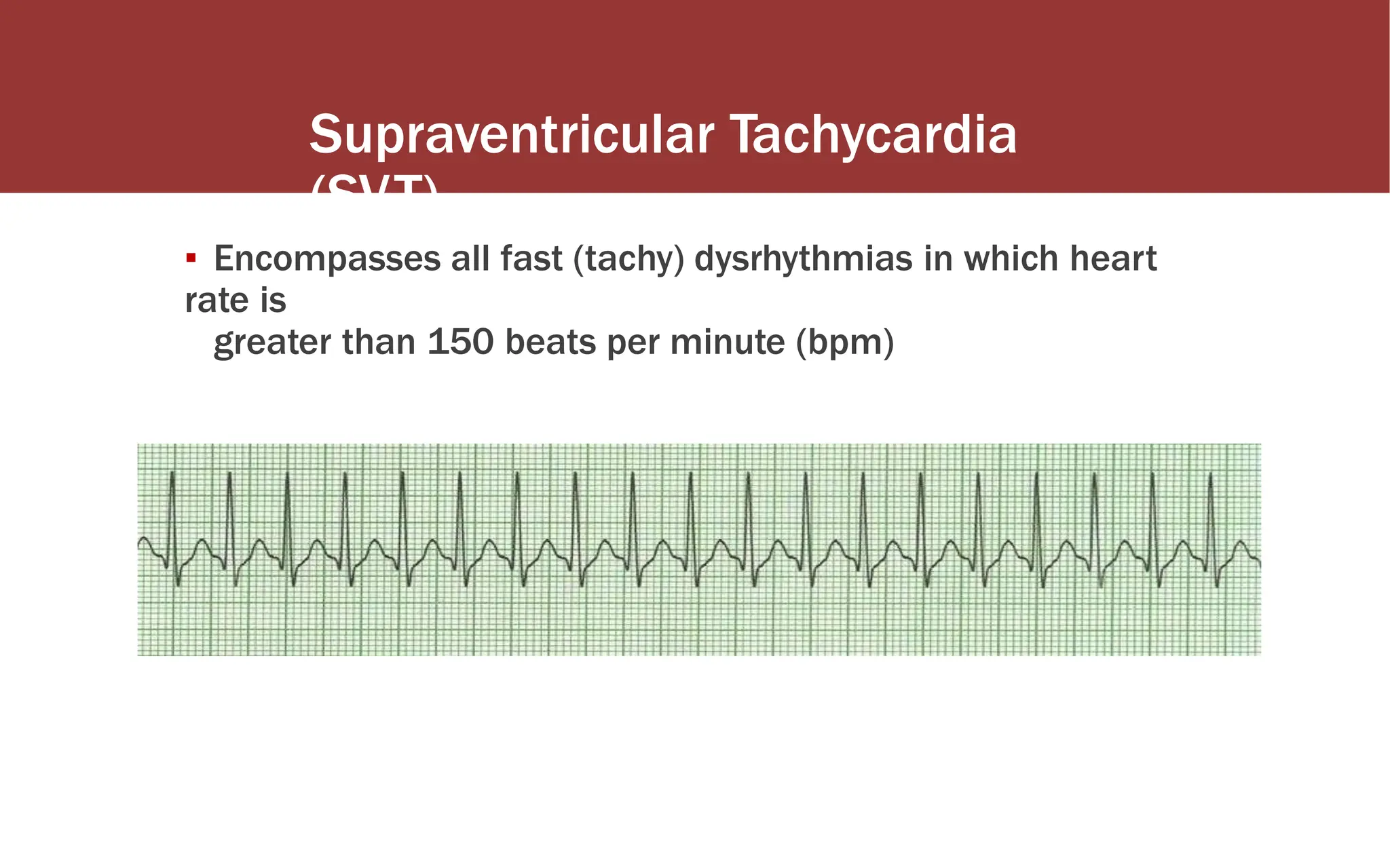 http://www.youtube.com/watch?v=d0YjiPTd55k&feature=channel&list=UL
Supraventricular Tachycardia
(SVT)
▪ Encompasses all fast (tachy) dysrhythmias in which heart
rate is
greater than 150 beats per minute (bpm)
 