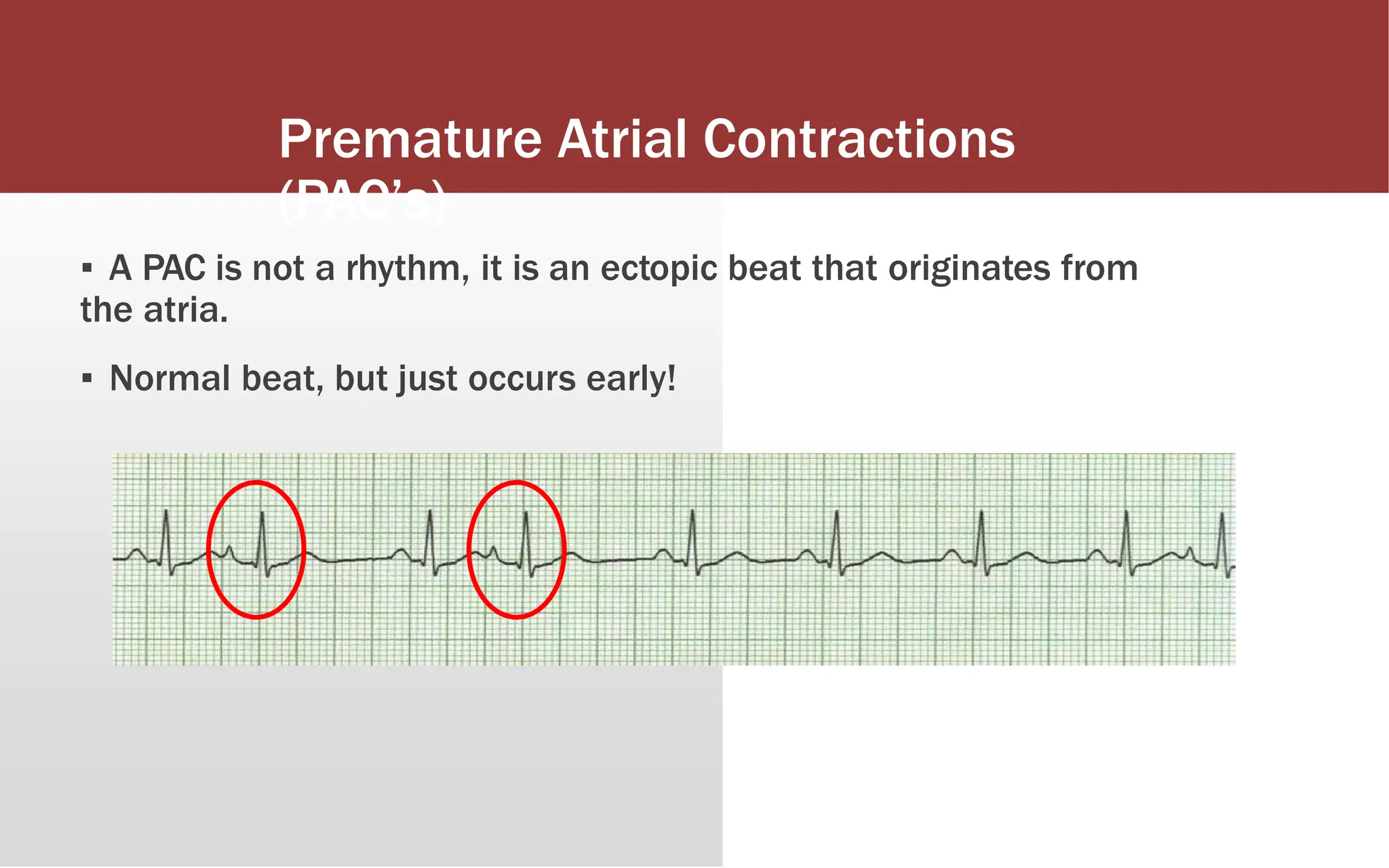 Premature Atrial Contractions
(PAC’s)
▪ A PAC is not a rhythm, it is an ectopic beat that originates from
the atria.
▪ Normal beat, but just occurs early!
 