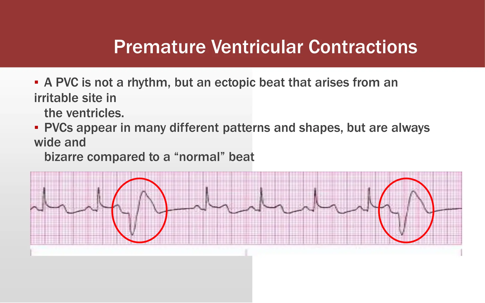 Premature Ventricular Contractions
▪ A PVC is not a rhythm, but an ectopic beat that arises from an
irritable site in
the ventricles.
▪ PVCs appear in many different patterns and shapes, but are always
wide and
bizarre compared to a “normal” beat
 